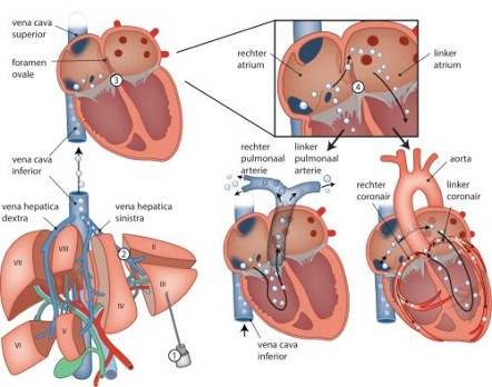 Coronaire CO2-embolie na pneumoperitoneum 