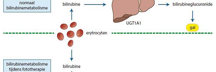 Een zeldzame oorzaak van neonatale cholestase 