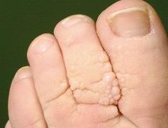 Lymfoedeem