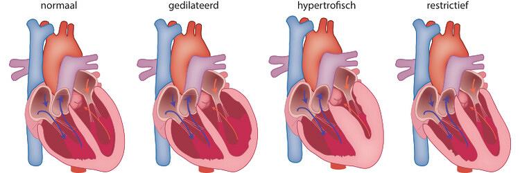 Cardiale betrokkenheid bij neuromusculaire aandoeningen