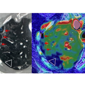 Trombose bij COVID-19-infectie