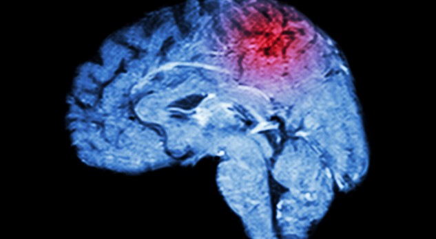 Acute behandeling en secundaire medicamenteuze preventie van een herseninfarct (0,5 StiPCO-punt)