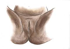 Vrouwelijke genitale verminking