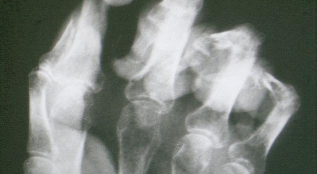 Multidisciplinaire richtlijn complex regionaal pijnsyndroom