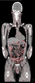 Vooruitgang en toekomstperspectieven van beeldvorming met FAPI-PET/CT