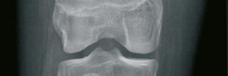 Quiz - Afwijkende botstructuur op kniefoto