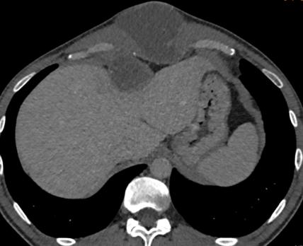 Quiz: man met zwelling in epigastrio
