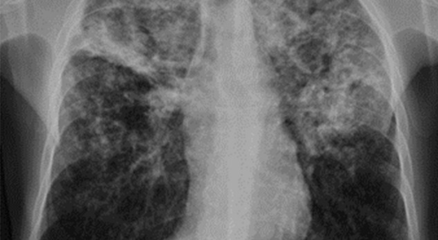 Tuberculose van het centrale zenuwstelsel 