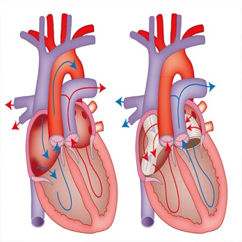 Preoperatieve evaluatie voor niet-cardiale chirurgie bij volwassenen met een aangeboren hartafwijking