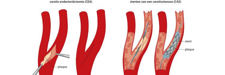  Cerebraal hyperperfusiesyndroom