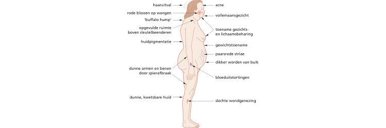 Syndroom van Cushing