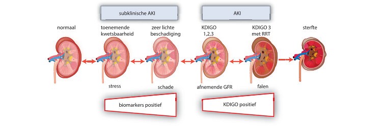 Acute nierschade na cardiochirurgie 