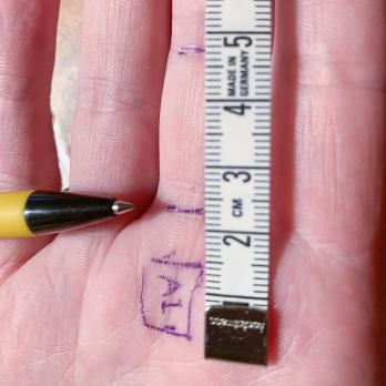 Triggerfinger: conservatief of operatief behandelen? (VI)