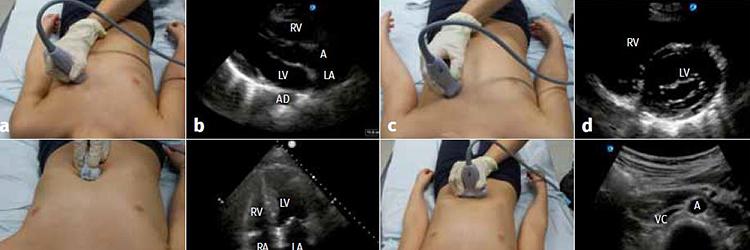 POCUS (point-of-care ultrasonography) bij het ernstig zieke kind