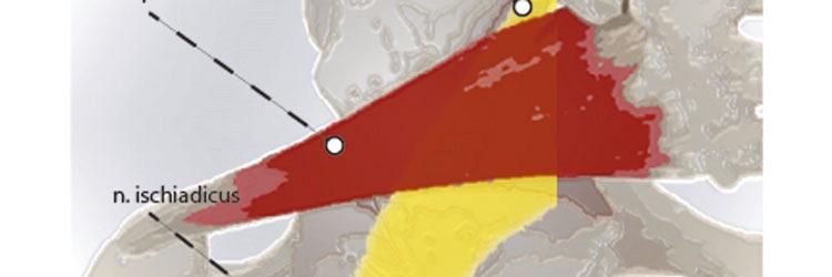 Het piriformissyndroom, bestaat het?