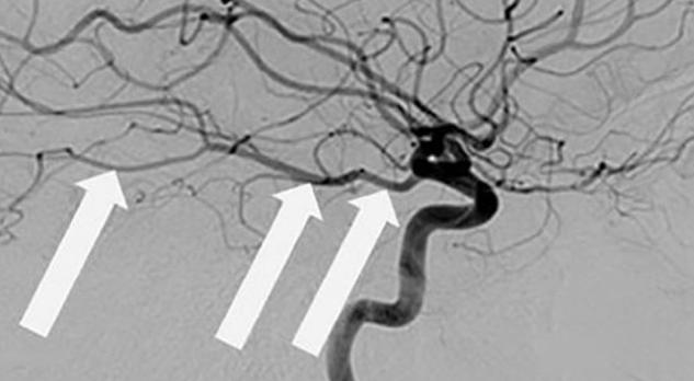 Carotisendarteriëctomie bij een patiënt met een occipitaal herseninfarct