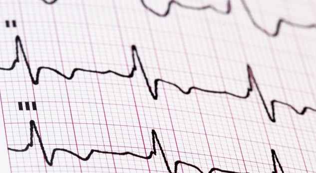 Achtergrond van aritmogene rechterventrikel cardiomyopathie