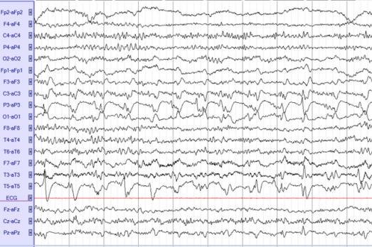 Focale status epilepticus bij volwassenen