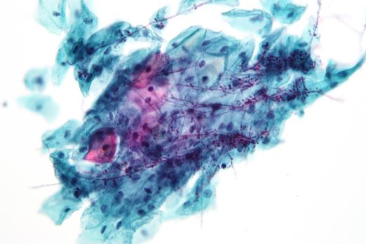 Fluor vaginalis