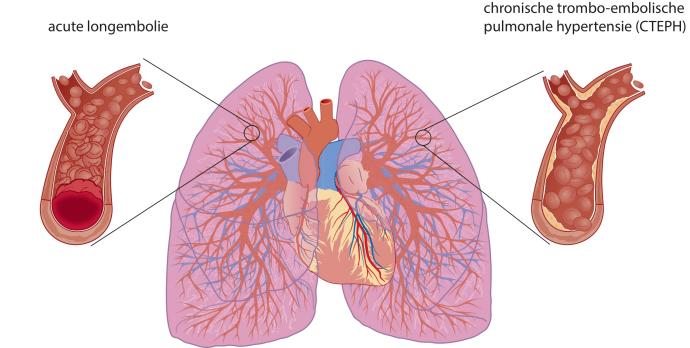 Chronische trombo-embolische pulmonale hypertensie