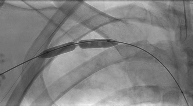 Armvenetrombose, veneus thoracic-outletsyndroom (VTOS)?