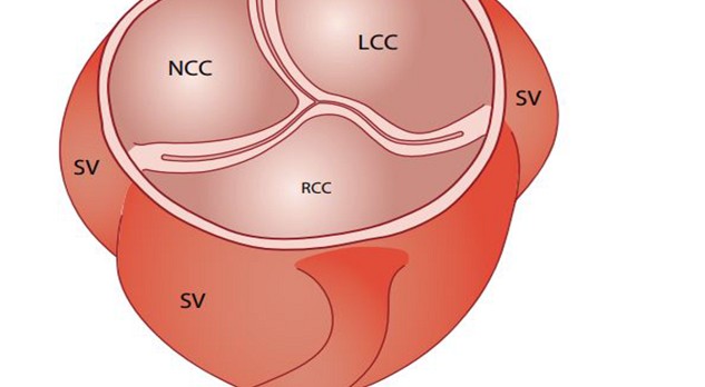 Aortaklepstenose