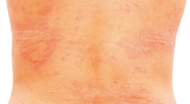 Urticaria en eczeem