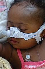 Chronische beademing bij kinderen