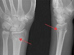 De distale radiusfractuur