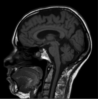 Radiologische evaluatie van patiënten met geheugenstoornissen