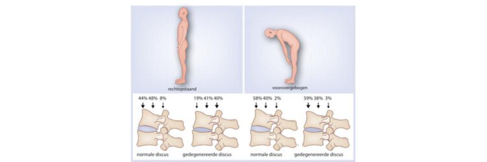 Het ‘zware’ leven van de lumbale disci intervertebrales (BD)