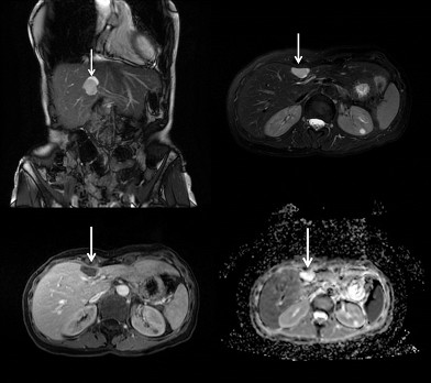 Hepatic ciliated foregut cyst 