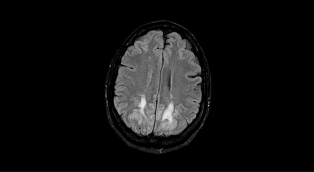 Neurologische complicaties van elektrolytstoornissen