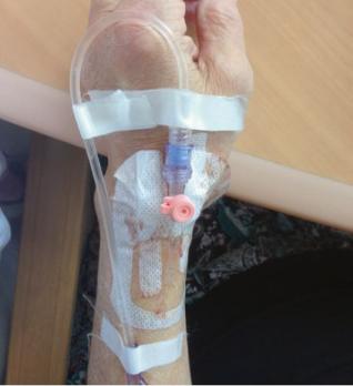 Complicaties van de perifere intraveneuze infuuscanule