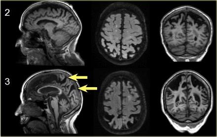 De ziekte van Alzheimer, achtergrond en diagnostiek 