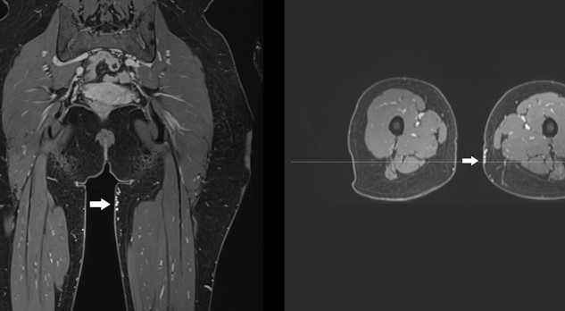 Pelvic congestion syndrome bestaat niet meer... of toch wel? 