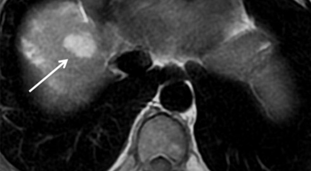 Screening op hepatocellulair carcinoom bij hoog-risicopatiënten