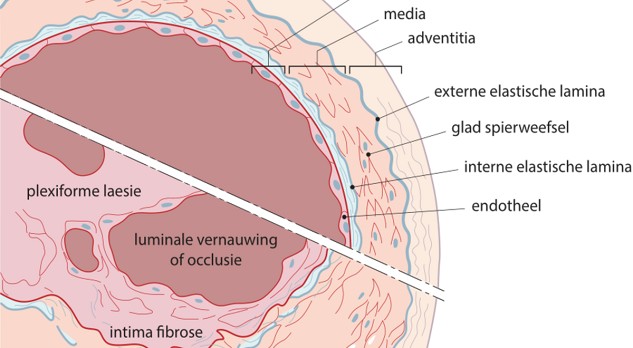 Classificatie van pulmonale hypertensie