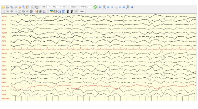 Neurologische complicaties op de IC