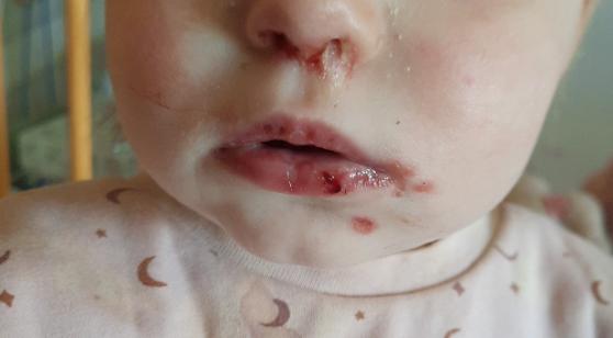 Plaatjespuzzel: een opmerkelijk beloop van een stomatitis