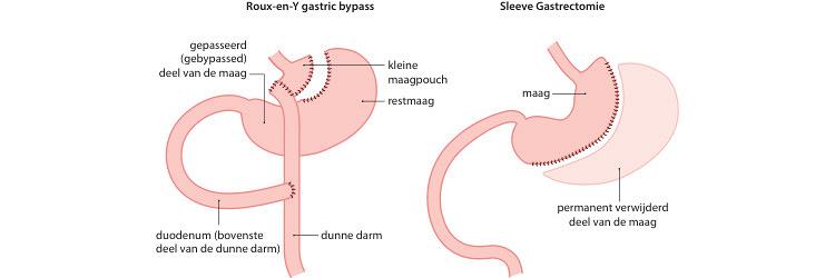 Effectiviteit van directe orale anticoagulantia na bariatrische chirurgie