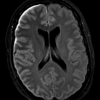 Listeria monocytogenes-meningitis 