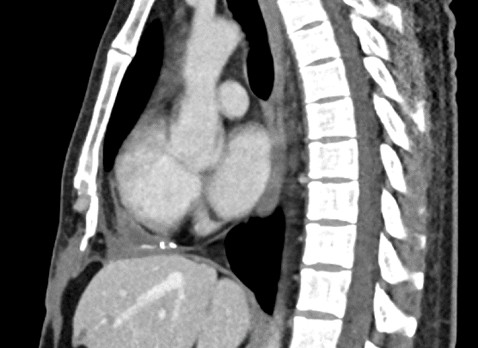 Man met zwelling in epigastrio