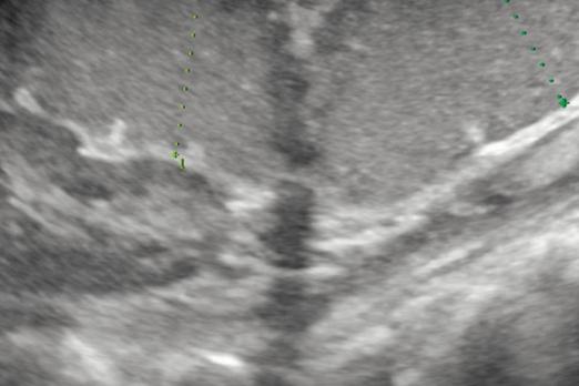 Echografie bij buikpijn