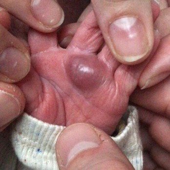 Plaatjespuzzel: een pasgeborene met een zwelling op de hand 