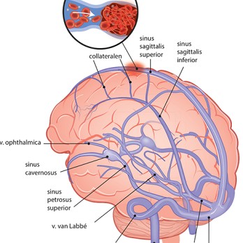 Cerebrale veneuze sinustrombose 