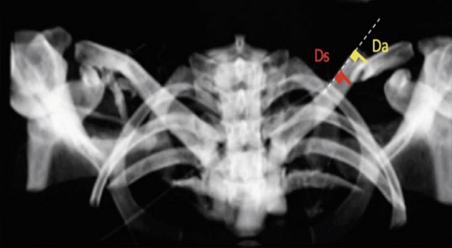 Optimalisatie van de radiologische evaluatie van midschacht claviculafracturen 