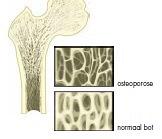 Osteoporose