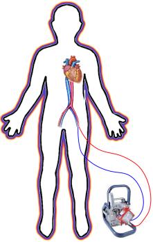 Extracorporele membraanoxygenatie (ECMO)