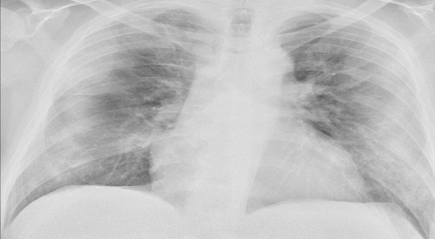 Thoracale beeldvorming bij COVID-19-infectie 